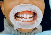 Bleeding Gums: What It Says About Your Health? Gums Healthy
